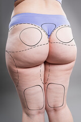 Buttocks liposuction, fat and cellulite removal, overweight female body with painted surgical lines, plastic surgery concept