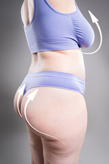 Buttocks liposuction, breast augmentation, fat and cellulite removal, overweight female body, plastic surgery concept