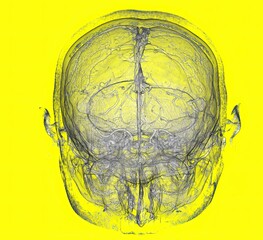 3D CT Angiography of Circle of Willis and Human Brain Vessels Anatomy