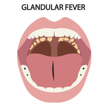 Vector illustration of glandular fever showing fatigue, sore throat, fever, swollen lymph nodes, with similar illnesses like tonsillitis, flu, and viral pharyngitis mouth icon