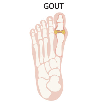 Vector illustration of gout showing joint inflammation, redness, swelling, and severe pain, with related conditions such as arthritis, pseudogout, and rheumatoid disorders leg skeleton