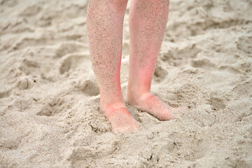 Close-up of feet partially buried in sand, highlighted by sunburned ankles. Overcast lighting softens ambient tones, creating relaxed beach atmosphere