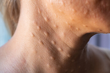 Fototapeta premium Woman's face after mesotherapy injections biorevitalization. beauty injections. High quality photo