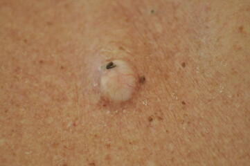 A protruding ulcer on a man's back.Highly Infected Sebaceous Cyst on Senior Man's Back