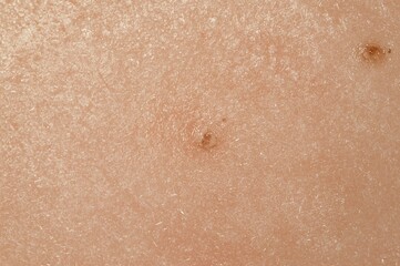 Fototapeta premium Close-up skin texture; moles; medical; background blur; dermatology