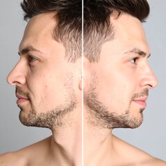 Obraz premium Mans Nose Reshaping Before and After Cosmetic Surgery.