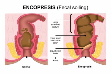 Encopresis (Fecal soiling) flashcard medical illustration