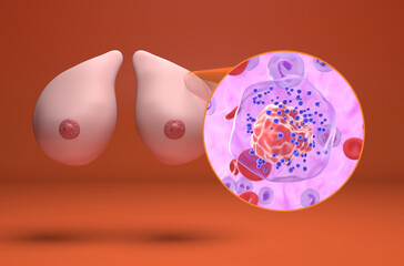 Triple-negative breast cancer (TNBC) - isometric view 3d illustration