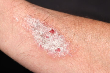 Hautkrankheit Psoriasis Schuppenflechte an Arm, schuppige entzündende juckende aufgekratzte Schuppen Haut