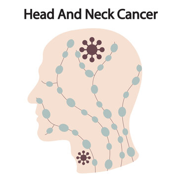 Vector illustration of head and neck cancer showing lumps, sores, voice change, swallowing pain, and weight loss, with related conditions like oral tumors, throat infections, and lymphoma brain
