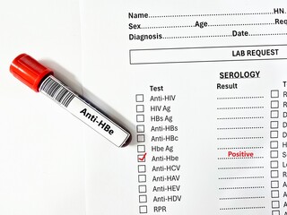 Blood sample tube positive result for anti-HBe.
