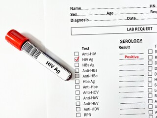 Blood sample tube positive result for HIV Ag.