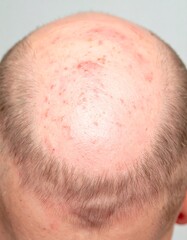 Bald scalp with skin irritation