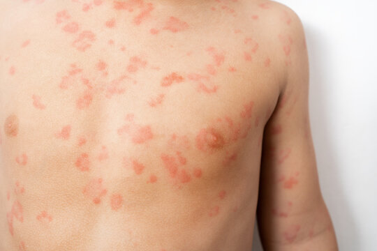 Close-up image of skin texture of a child with severe hives or welts or kaligata on chest. Allergy symptoms.