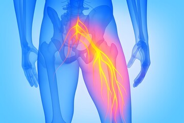 Medical Illustration of Sciatic Nerve Inflammation