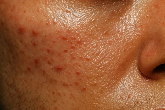 Closeup of male face with acne pimples and oily skin showing inflamed pores.