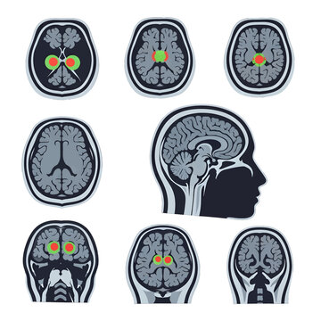Medical Brain Scan Anatomy Illustration with Green and Red Regions on White Background