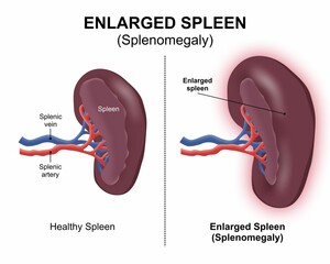 Enlarged Spleen (Splenomegaly) spleen flashcard illustration