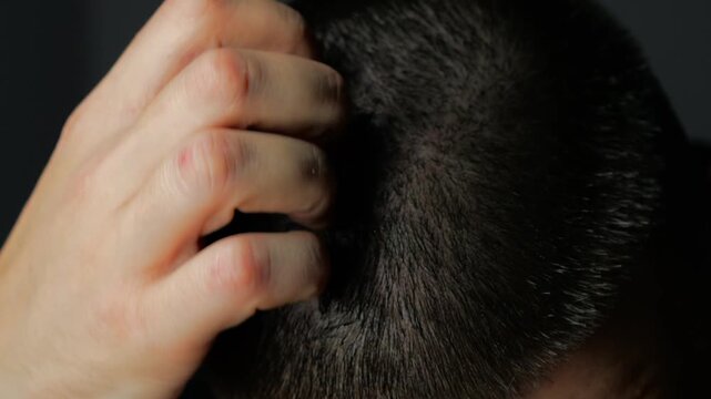 Brunette with short hair scratches his head with his hands because of dry scalp.
Itchy scalp in an adult.
Discomfort and itching of the head.
Treatment of dermatitis and psoriasis