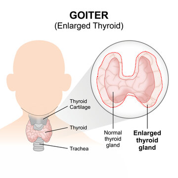 Goiter - Enlarged thyroid, flashcard illustration