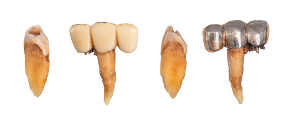periodontitis disease, Close-up of teeth with severe calculus and decay. Dental hygiene issue,...