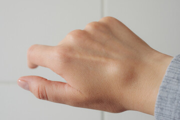Female right back hand with ganglion cyst on the dorsum,  fluid-filled bump associated with a joint or tendon sheath, close-up view, selected focus.