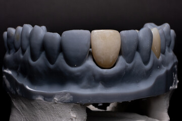 High-quality dental single crowns made of zirconium for fixation to the lateral upper jaw incisors © Алена Пахомова
