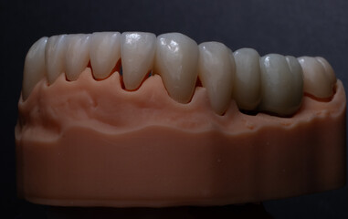 Total prosthetics. Zirconia dental crowns on a lower jaw model in aesthetic dentistry.