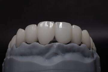 Total prosthetics. PMMA resin teeth for prosthetic creation on a upper jaw model, zirconium crowns in aesthetic dentistry. Porcelain crowns for front teeth. © Алена Пахомова