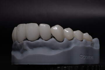 Total prosthetics. PMMA resin teeth for prosthetic creation on a upper jaw model, zirconium crowns in aesthetic dentistry. © Алена Пахомова