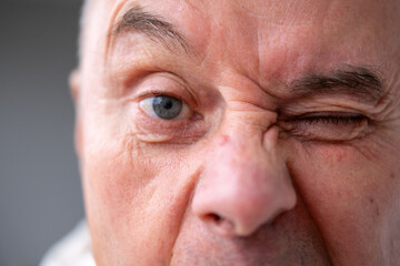 Close up mature senior man, fatigue syndrome eye pain symptoms, including strain, allergies, blocked, lacrimal duct, severe irritated eye conditions, corneal ulcers, tear gland, ocular health