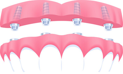 Upper teeth (All-on-4 dental implants) illustration transparent design. Dental care concept.