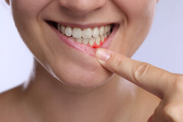 Woman showing inflamed gum on light background, closeup
