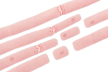 Myelinated Nerve Fiber Illustration Showing Demyelination [Illustration]