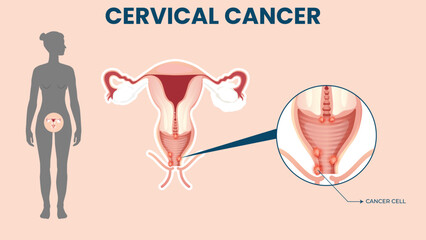 Cervical Cancer Awareness Concept with Medical Illustration