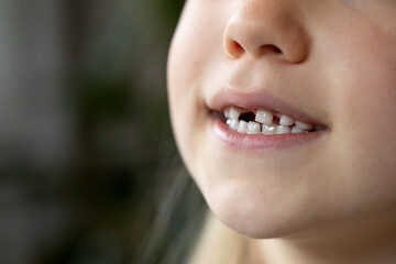 A child with missing teeth smiles in close-up. Loss of baby teeth. Caring for children's teeth