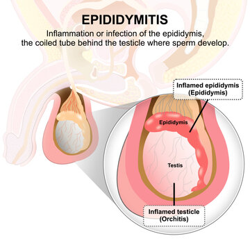Epididymitis inflamed testis medical flashcard illustration