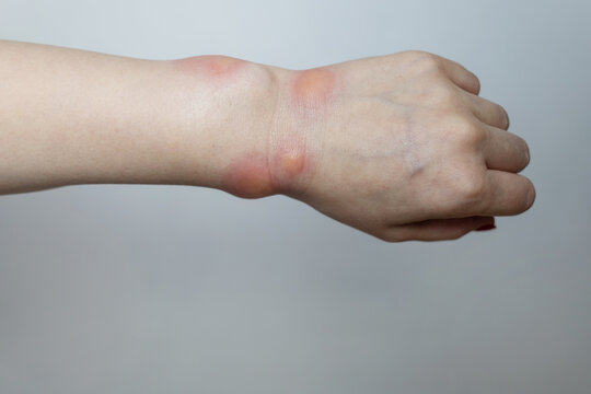 Close up of a swollen wrist with visible redness, inflammation, caused by an insect bite or allergic reaction. The hand signs of rash, itching, and local pain, typical of mosquito bites, bee stings