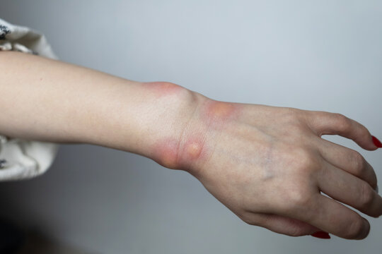 Close up of a swollen wrist with visible redness, inflammation, caused by an insect bite or allergic reaction. The hand signs of rash, itching, and local pain, typical of mosquito bites, bee stings