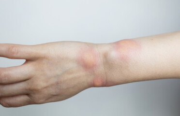 Close up of a swollen wrist with visible redness, inflammation, caused by an insect bite or...