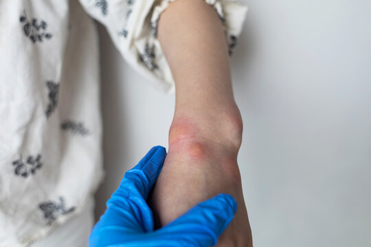 Close up of a swollen wrist with visible redness, inflammation, caused by an insect bite or allergic reaction. The hand signs of rash, itching, and local pain, typical of mosquito bites, bee stings