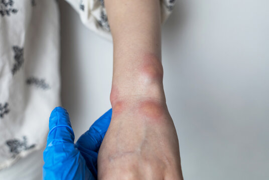 Close up of a swollen wrist with visible redness, inflammation, caused by an insect bite or allergic reaction. The hand signs of rash, itching, and local pain, typical of mosquito bites, bee stings