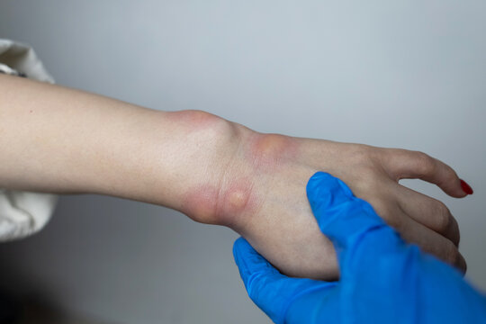 Close up of a swollen wrist with visible redness, inflammation, caused by an insect bite or allergic reaction. The hand signs of rash, itching, and local pain, typical of mosquito bites, bee stings