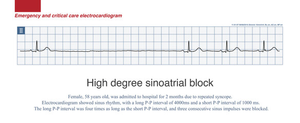 When the long P-P interval is an integral multiple of the basic sinus P-P interval, it is sinoatrial block. When it is more than 2 times, it is a high sinus block.
