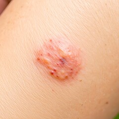 Fototapeta premium Skin rash on human leg