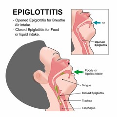 Epiglottitis (Open and Close) ENT medical flashcard illustration