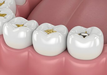 A close up of three teeth with fillings in a pink gumline showcasing dental restorations close view