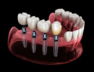 Dental implant restoration, multiple teeth