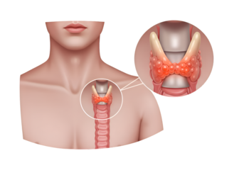 Medical illustration of a human neck and throat, highlighting the thyroid gland's anatomy.