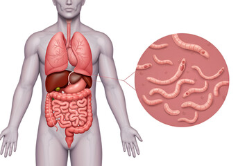 Detailed anatomical illustration of the human body, highlighting internal organs and parasitic worms.